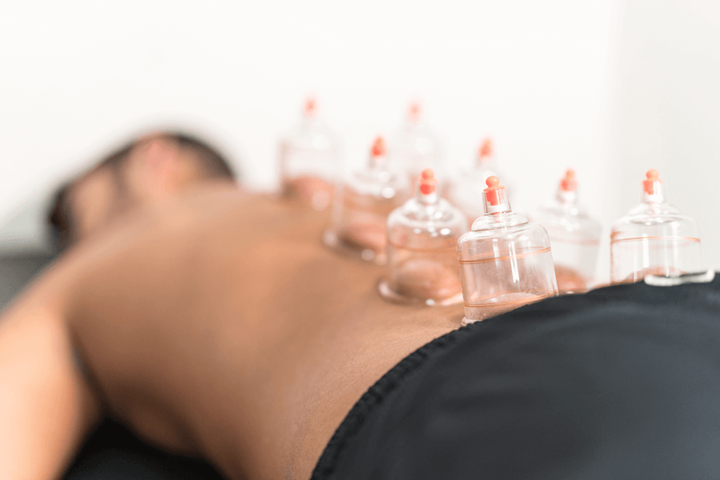 Acupuncture without needles - cupping on back muscles