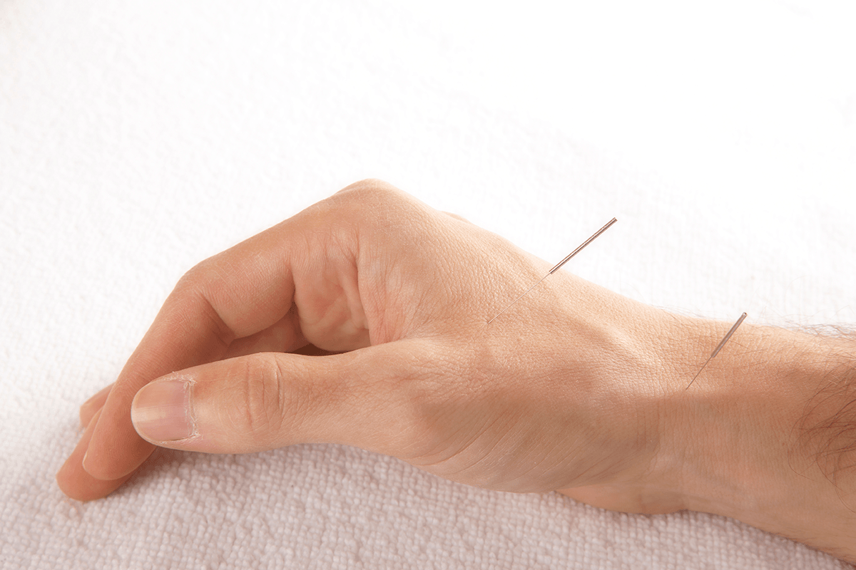 Hand with two acupuncture needles in