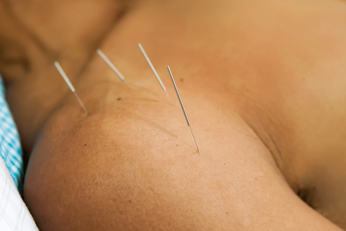What is Electro-acupuncture and how can it help me? - Lucy Clarke  Acupuncture