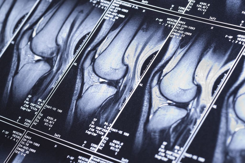 MRI scan of knee treating pain and discomfort 