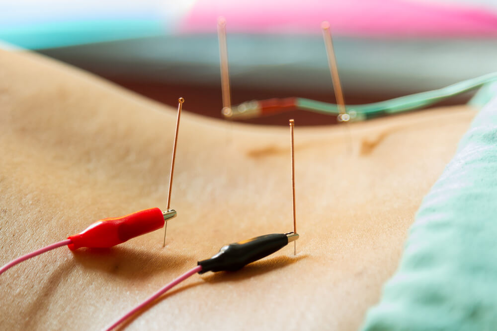 Image of Electro-acupuncture